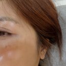 에덴빌 | 전주대플라즈마 후기｜3일차 딱지 후기 색소침착 케어 경과