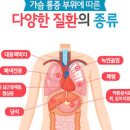 폐색전증 증상 진단 치료, 기본정보 (가슴 흉통, 호흡곤란, 객혈) 이미지