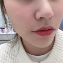 압구정 피부과 쥬베룩볼륨 후기 그리고 통증
