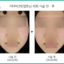 엘림피부과의원 | [부평 색소치료] 20대 여성, 더마피코듀얼토닝 10회로 잡티 + 피부결 개선
