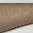 차영수피부과의원 | [분당 정자동 피부과] 차영수피부과 피부낭종 수술 후기