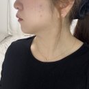 송파 문정 온오프피부과 이중턱리프팅 온다로 해결한 내돈내산 후기