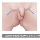 남자 요도하열 잠복고환 원인 증상 치료 이미지