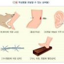 파상풍 초기증상 어떤 증상이 나타나는지 알고 계신 가요 이미지