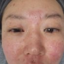 씨유 사당이수점 | (일상) 여드름 흉터제거 - 플라즈마 블라스트 후기 이수드가비(1)