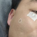 광주리팟레이저 흑자제거 잡티 관리 내돈내산 찐후기
