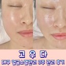대구 얼굴소멸관리 주1회 3주간 고우다에서 관리해 본 솔직후기