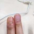 듣는마음이선호정형외과의원 | 부산 명지 정형외과 조갑주위염 후기