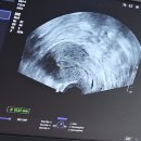 보름달약국 | [갑상선기능항진증 환자의 임신준비] 2025.07.06 - 2025.08.04 시험관 3차 5일 배양 동결 배아 이식 후기