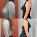 연지고병 | [결혼 준비] 일산 365 팔뚝 무한람스, 당일/일주일/후관리 후기