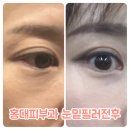 홍대역 피부과 눈밑필러 후기 / 전후 / 부작용