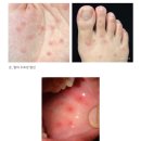 아이메디케어 | [베트남:하노이] 아기 수족구병 아이메디케어 병원 방문 후기