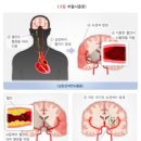 [통합간편]뇌졸중 진단비 특별약관 이미지