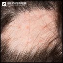 경대에스디의원 | 대구모발이식잘하는곳 특징은 ‘이것’ <대표원장 작성>