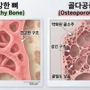 뼈의 소리 없는 아우성, 골다공증 바로 알기 [브레인트레이닝센터] 이미지