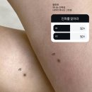 뷰티플렉스 미인만들기 | 광안리 미인점 | 부작용 없이 매력적인 포인트를 위한 미인점 시술전 알아야할 점