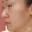 광주 첨단 피부과 잡티레이저 후기