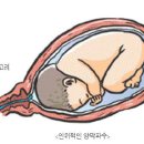 분만촉진을 위한 방법 - 유도분만 이미지