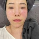 브이에스라인의원 | 일산 온다리프팅 2회차(feat. 일산브이에스라인의원) l 내돈내산