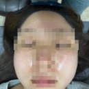 광주기미제거 확실하게 해주는 첨단에스테틱 제이샵뷰티