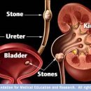 Kidney stones 이미지
