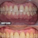 지지골 | 앞니 치주염으로 흔들림, 발치 즉시 임플란트 뼈이식 잇몸이식 임시치아 후기