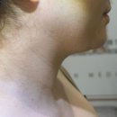 발견 | 부산 편평사마귀, 무제한 제거 성지 발견 후기!