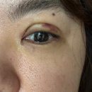 대구 쌍수 내돈내산 붓기 관리템 추천 / 완전절개,눈매교정,윗트임 쌍수 준비물(다이소,쿠팡)