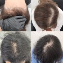 뮬리성형외과의원 | 천안아산SMP(두피문신)두피탈모 휑하다면...