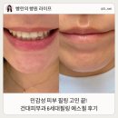 건대피부과 예스필 6세대필링 예민한 피부도 가능