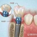 우리들치과보철과치과의원 | 칠곡3지구치과 임플란트 보철 교체해야 되나요?