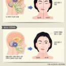 벨 마비 원인[스트레스, 과식, 과음, 신경예민] 이미지