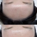 세인자연 | 인천 부평 세인왁싱 헤어라인 관리 후기 | 부평페이스왁싱 추천