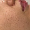비비 피앤피 - 12053 | 광주여드름관리 피앤피뷰티연구소에서 (콜마레플라즈마,나노필) 관리 후기