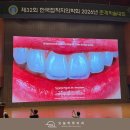 라인아트치과기공소 | 문정치과 최소삭제 라미네이트, 얼마나 삭제할지 어떻게 결정할까?[4편]