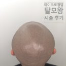 (주)마이크로청담 | 삭발문신 마이크로청담 탈모왕만의 시그니처 삭발두피문신st
