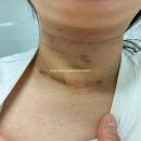 두   암 | 투병기록:: 갑상선암 수술 후기 3 수술비용, 회복기간, 수술흉터