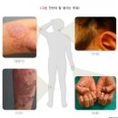 인셀덤서윤 | 리만코리아 인셀덤 화장품 효능 부작용 후기 (건선피부 치료) 대박