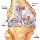 퇴행성 관절염 (degenerative arthritis) 이미지