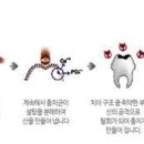 치통이 심할 때 해결법 충치 통증 원인 단계 예방 이미지