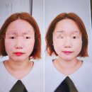 개포동피부과에서 고주파리프팅 텐써마 받은 후기