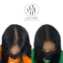 강귤 | 용산 두피문신(SMP) 가격 후기 여성 가르 탈모 자연스럽게 커버한 리얼 변화