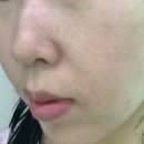 구디피부과 스킨부스터 콜라스터 후기 내돈내산