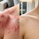몸에 빨간 두드러기 반점 증상 케어 후기