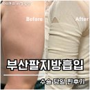천성약국 | 부산팔지방흡입 당일 수술 찐후기 (feat.통증,붓기,출근,팔올림정도)