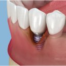 김남윤치주과치과의원 | 중랑구치과잘하는곳, 보철과와 치주과 진료 함께 고려해야 하는 이유는?
