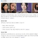 강남봄약국 | 수지도 제거한 눈 흰자의 점 [결막모반 제거] 레이저수술 후기 feat. 강남 안과