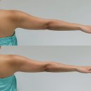 장유프라자 | [고운빛깔] 장유 신부관리 온다리프팅 팔 관리 후기