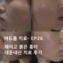 약초한의원 | 여드름 자국 / 패인흉터 잠실여드름한의원 치료 후기, 미세약초침 솔직 후기