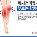 하지정맥류예방 여름에 더욱더 주의해야 하는 이유 이미지